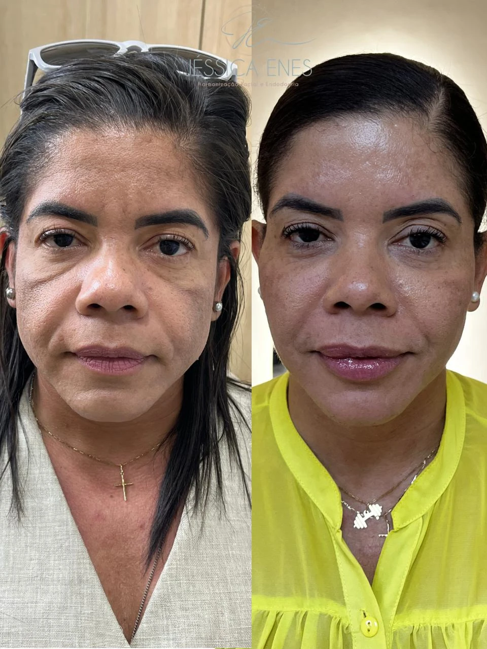 Antes e depois de harmonização facial (vista frontal)