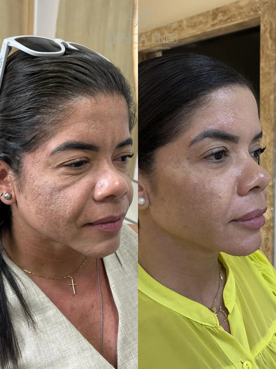 Antes e depois de harmonização facial (perfil 3/4)
