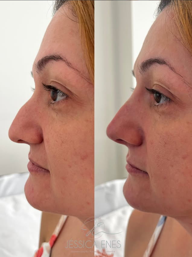 Antes e depois de harmonização facial (perfil)