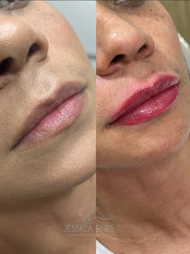 Antes e depois de preenchimento labial