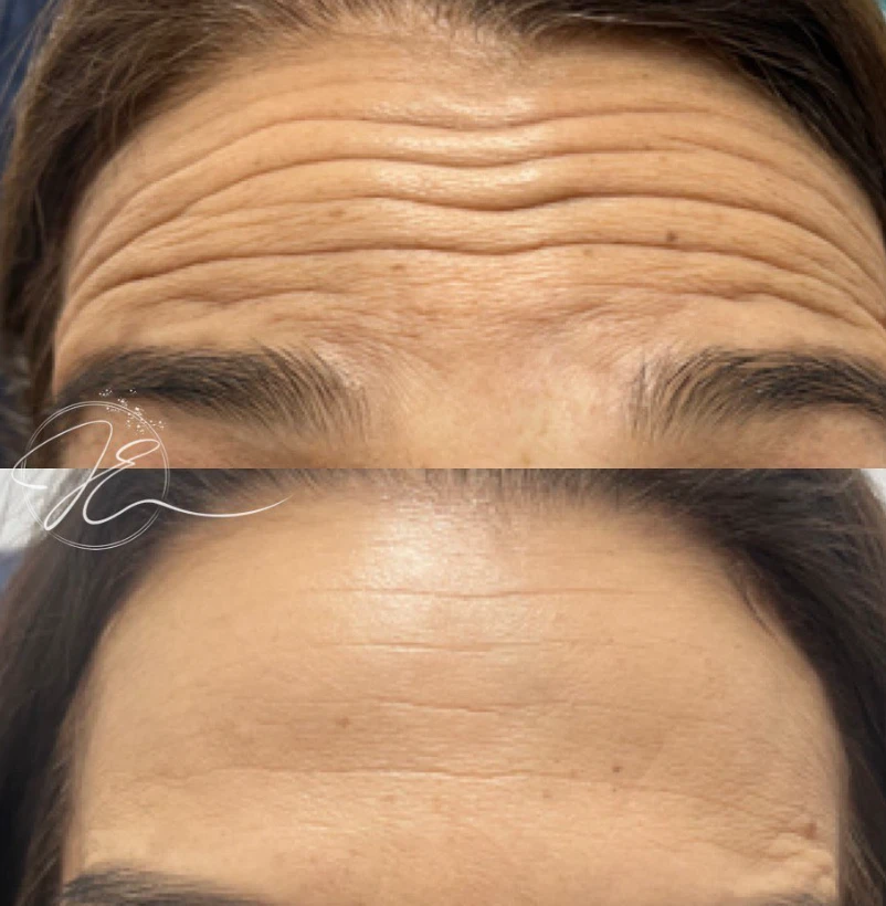 Antes e depois de toxina botulínica na testa