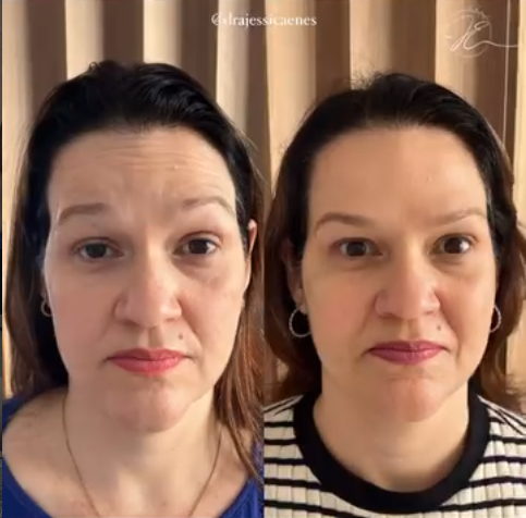 Antes e depois de harmonização facial (vista frontal)