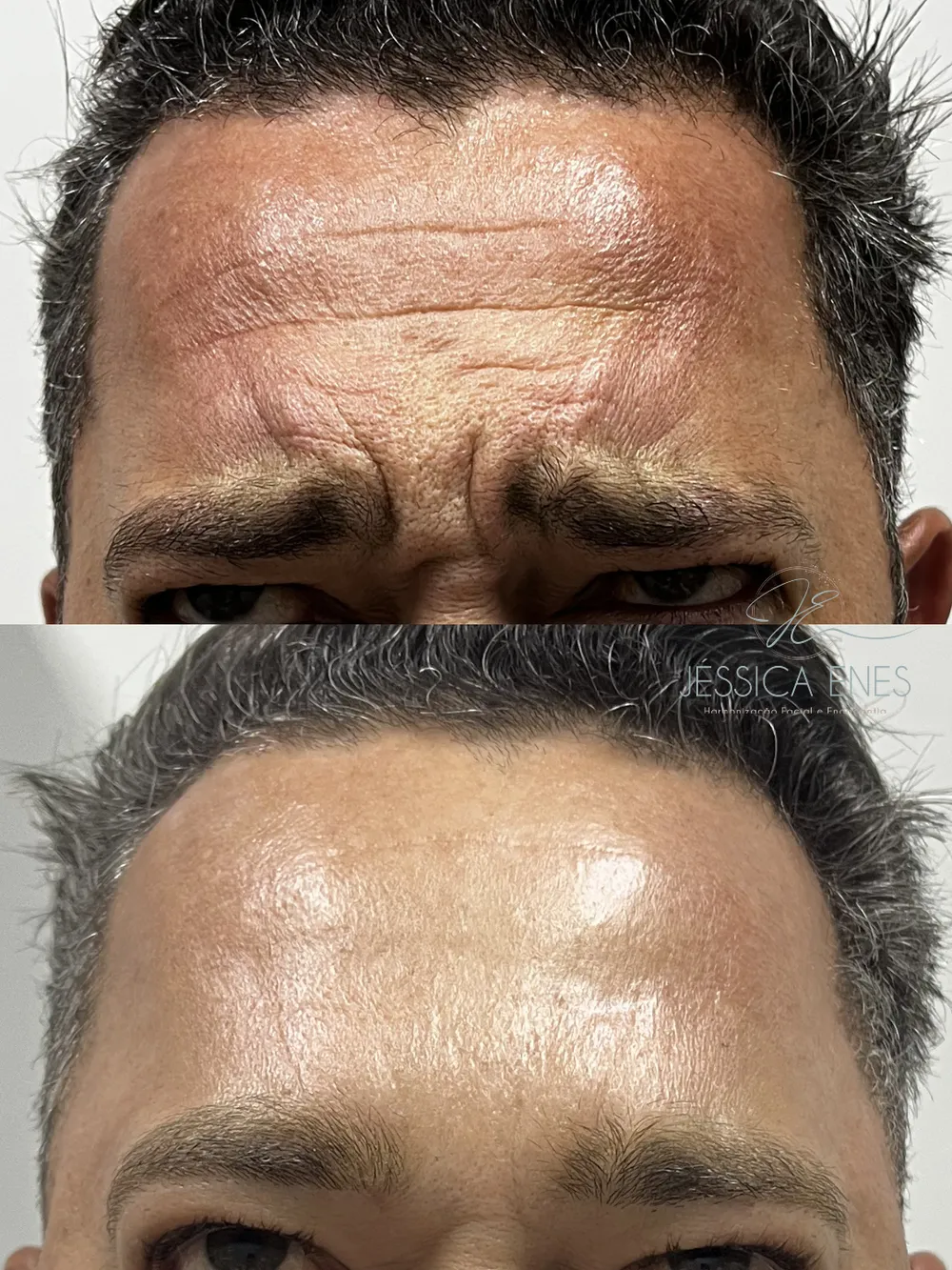 Antes e depois de toxina botulínica na testa (paciente masculino)
